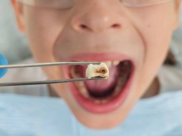 Best Emergency Wisdom Teeth Removal in Williamson, AZ
